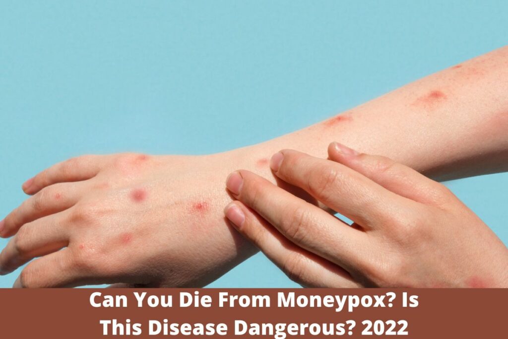 Can You Die From Moneypox Is This Disease Dangerous 2022