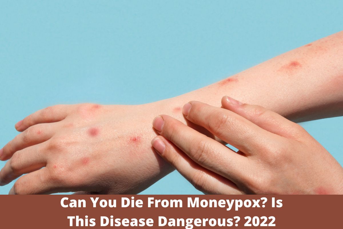 Can You Die From Moneypox Is This Disease Dangerous 2022