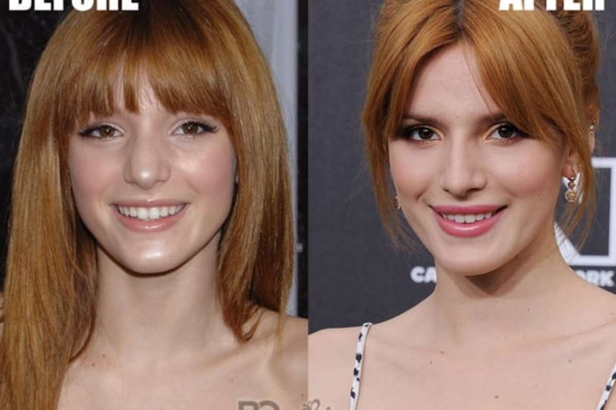 bella thorne plastic surgery