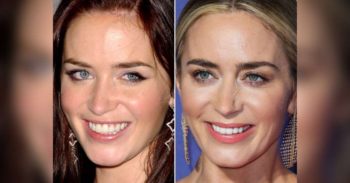 emily blunt plastic surgery before and after